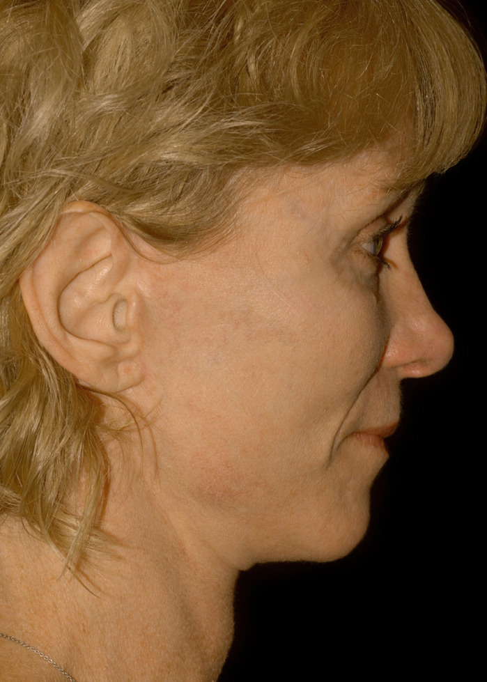 Cheek Lift Before & After Image